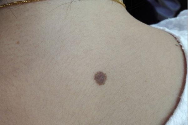 身上的黑点，是黑痣还是色素瘤？学好区分方法，皮肤癌或能远离你