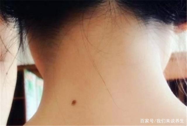 为什么很多人脖子后面有一颗痣？是什么原因？今天来告诉各位答案