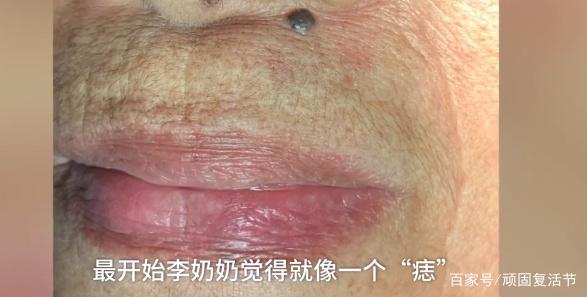 70岁老奶奶鼻子下长“痣”，以为是“福痣”，一查竟是细胞癌